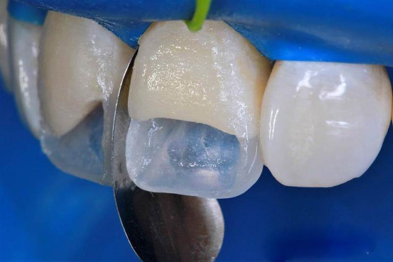 преимущества наращивания зубов Одесса