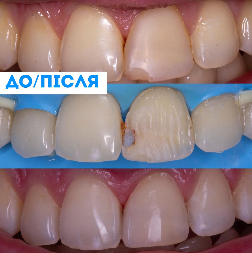 реставрация зубов - до/после