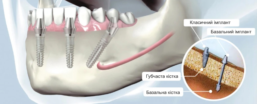 міфи про імплантацію зубів
