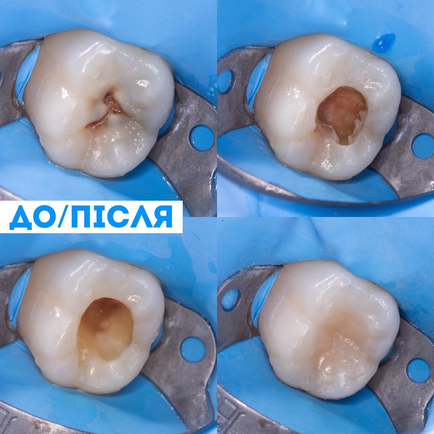 Лікування зубів в Одесі