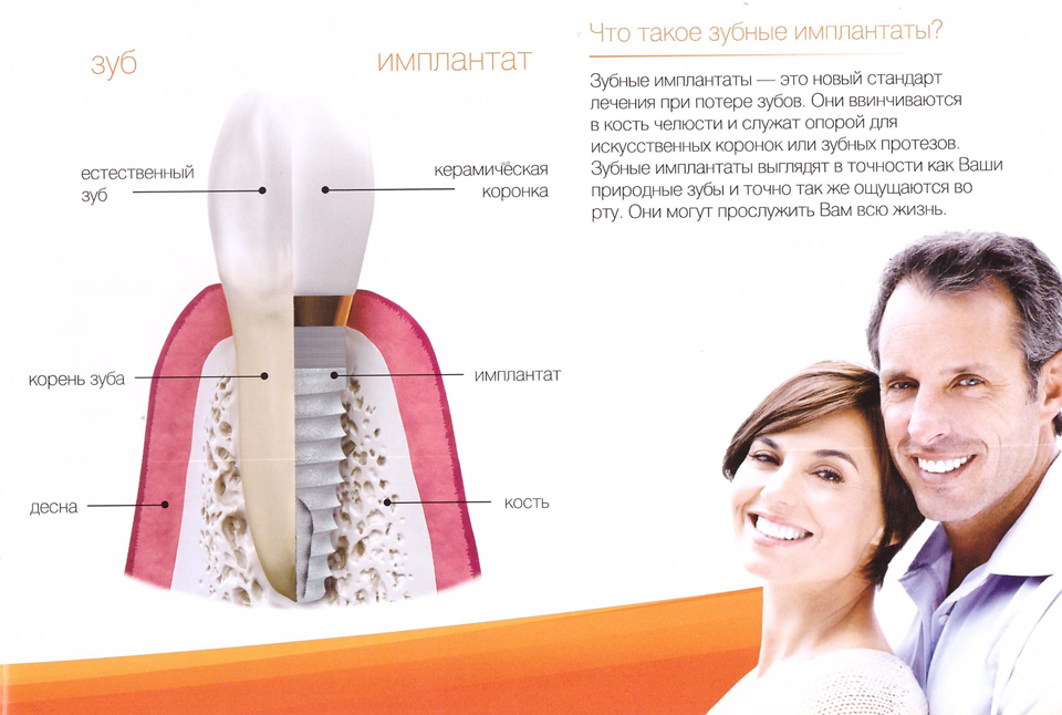 Зубной имплант
