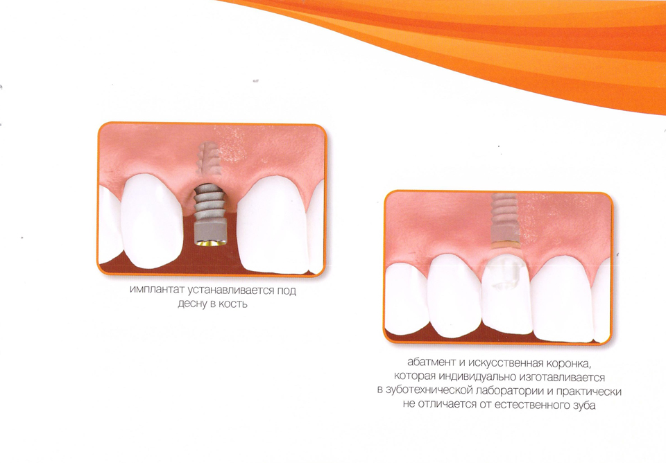 Установка зубного импланта на верхнюю челюсть