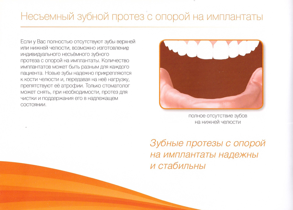Несьемный зубной протез с опорой на импланты