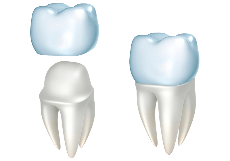 установка коронки из диоксида циркония Одесса