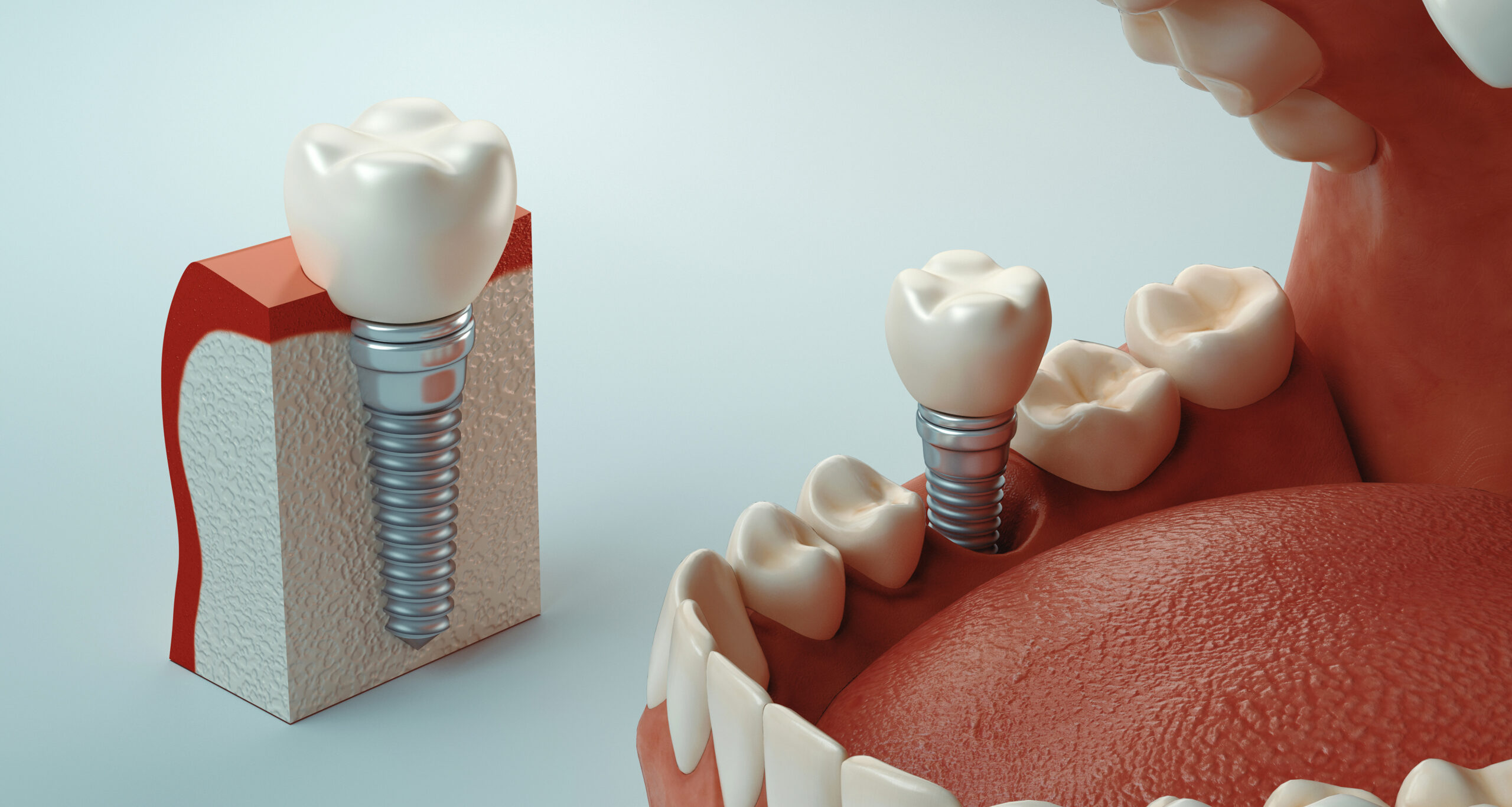 міфи про зубні імпланти
