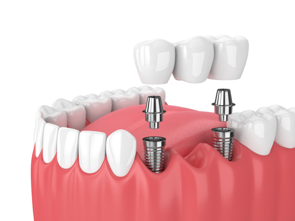 Протипоказання для імплантації зубів Одеса