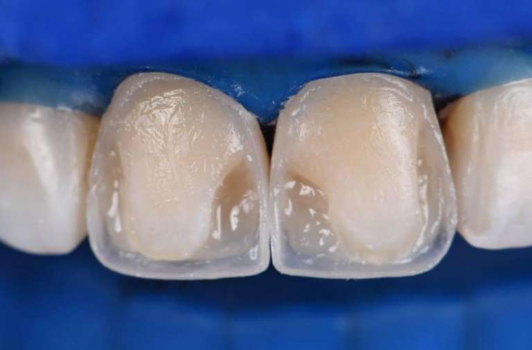 Як відбувається нарощування зубів Одеса