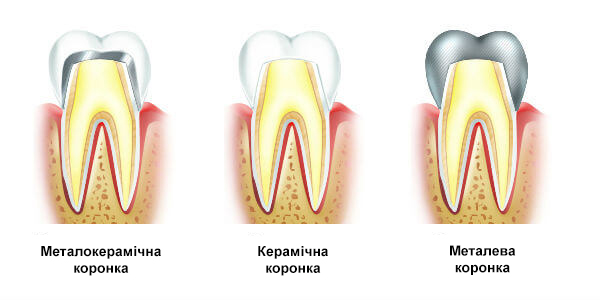 Види протезів на зуби