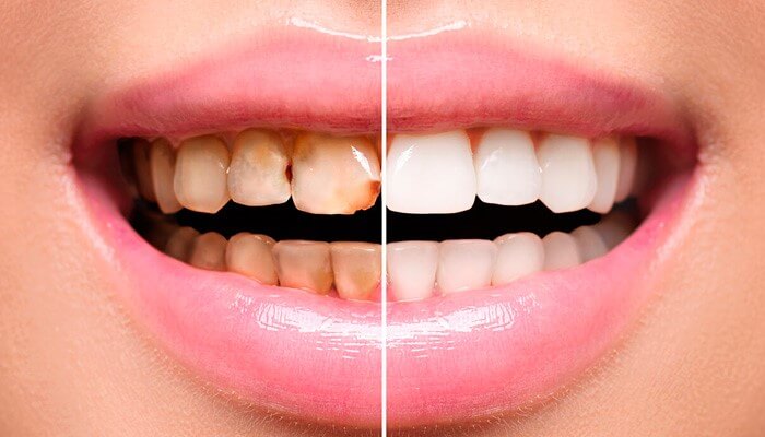 Результат художньої реставрації зубів