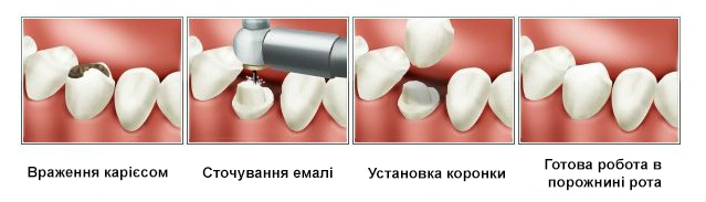 Встановлення металокерамічних коронок на зуб в Одесі